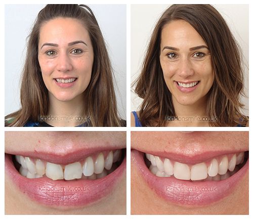 Composite Bonding: Customising Your Smile with Precision and Care